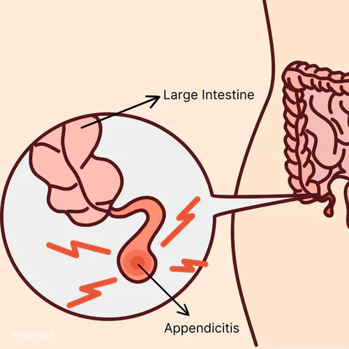 Signs of Appendicitis in Kids